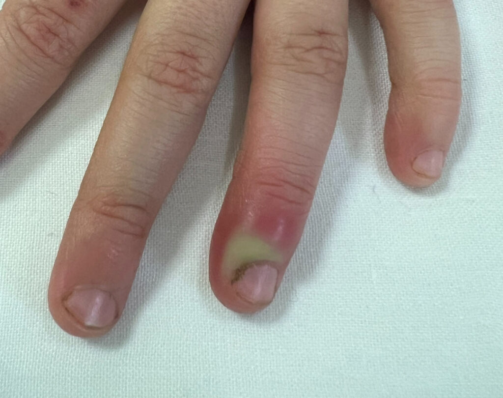 Nail Conditions Treatments at SkinVive in Hyderabad by Dr. Karishni Chittarvu