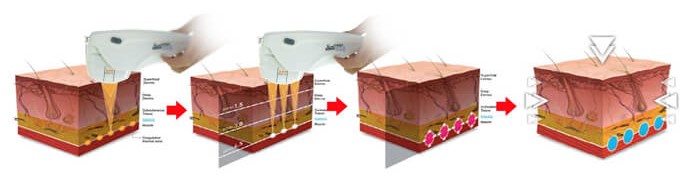 HIFU Anti Aging Treatment in Hyderabad at SkinVive by Dr. Karishni Chittarvu